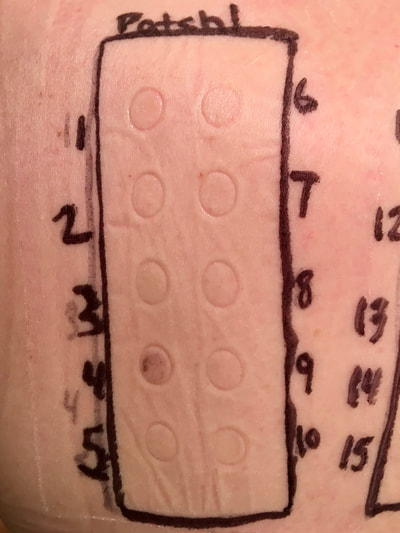 contact allergy patch test, positive result