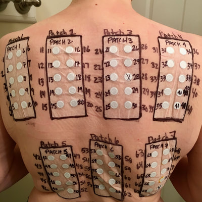 contact allergy patch test, back
